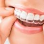 How Does Invisalign Works