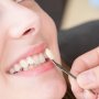 What Are Dental Veneers?